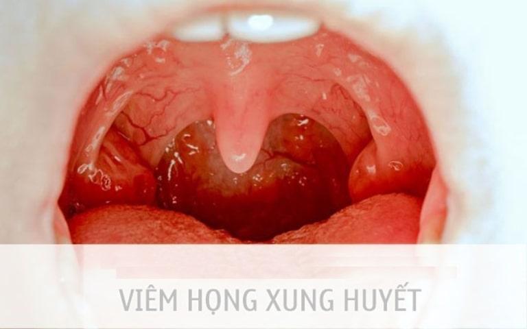 Viêm họng khiến trẻ đau đớn, quấy khóc và bỏ ăn