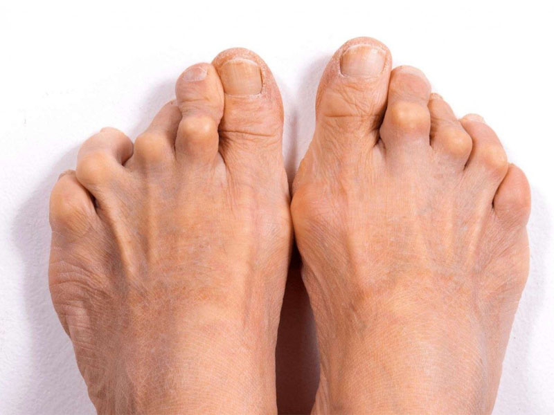 viêm khớp là gì