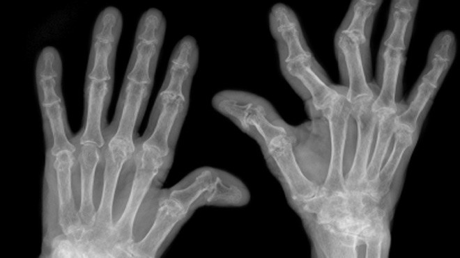 viêm khớp dạng thấp