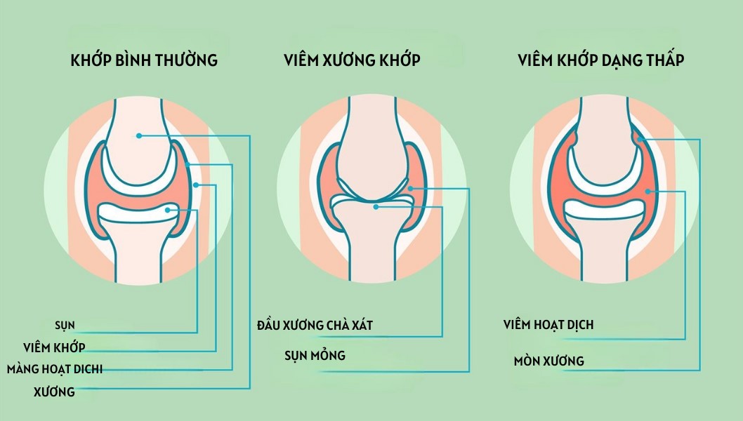 Viêm khớp dạng thấp và viêm xương khớp