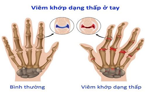 viêm khớp dạng thấp
