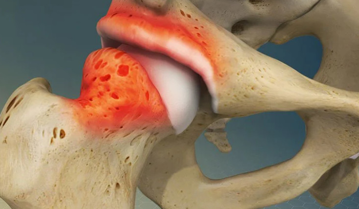 Viêm khớp háng ở trẻ em là bệnh lý khiến vùng khớp háng bị viêm, sưng nề