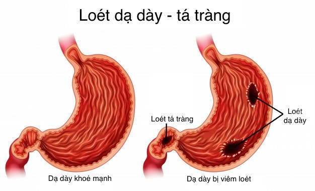 Viêm loét dạ dày tá tràng là nguyên nhân thường gặp gây tình trạng ăn không tiêu