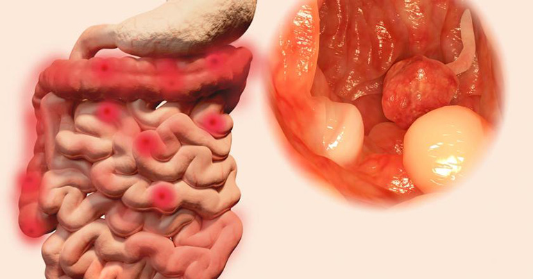 Viêm loét đại tràng có thể dẫn tới ung thư