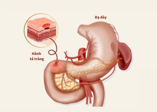 Viêm hành tá tràng là gì?  Hành tá tràng là điểm tiếp nhận đầu tiên khi thức ăn chuyển từ dạ dày xuống ruột non để tiêu hóa. Hành tá tràng và tá tràng là nơi dịch mật và dịch tụy đổ vào ruột non, có nhiệm vụ đưa thức ăn chuyển xuống ruột non, đồng thời hấp thụ nước và chất dinh dưỡng trước khi chúng tiếp tục di chuyển đi. Viêm hành tá tràng là tình trạng viêm nhiễm tại hành tá tràng.  Theo Hội khoa học Tiêu hóa, tại Việt Nam có tới 26% dân số mắc bệnh viêm loét dạ dày tá tràng. Đặc biệt, viêm loét dạ dày hành tá tràng có thể tiến triển thành ung thư với tỉ lệ cao. 