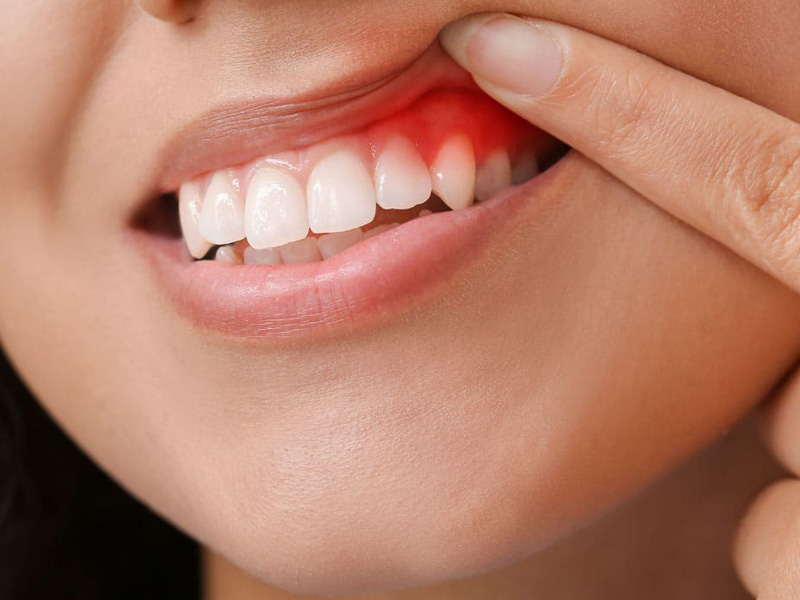 Viêm lợi uống thuốc gì 