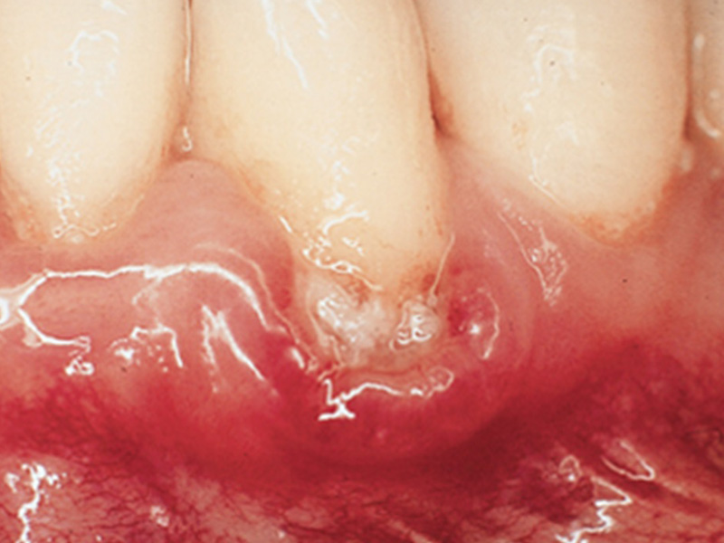 Viêm lợi uống thuốc gì 