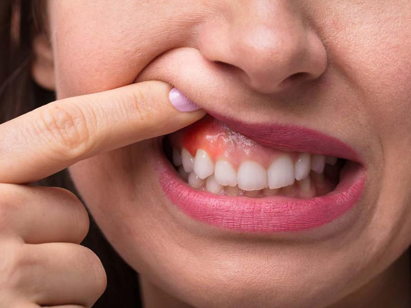 bị viêm lợi phải làm sao