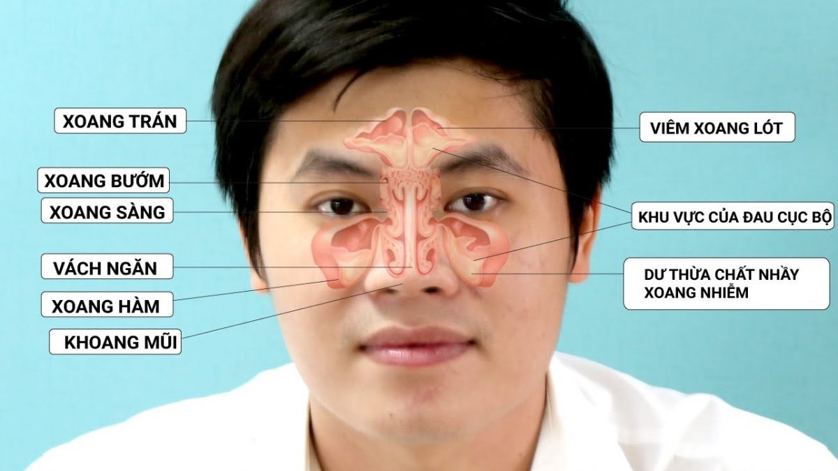 Viêm mũi xoang cấp