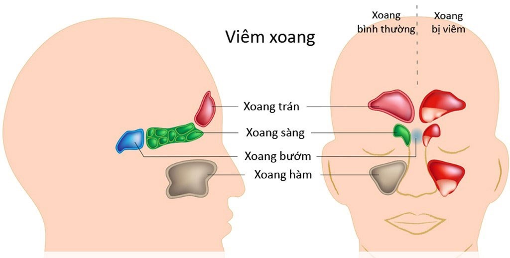Viêm mũi xoang là khi dịch nhầy ứ đọng trong các xoang