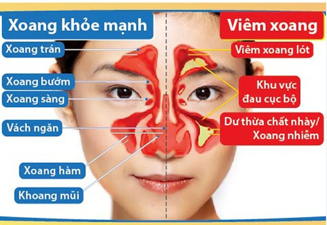 Viêm mũi xoang mãn tính do nhiều nguyên nhân gây ra