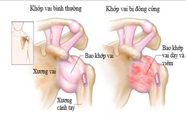 viêm quanh khớp vai