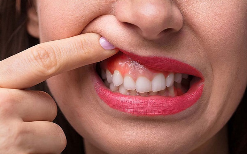 Viêm sưng nướu răng có nhiều triệu chứng dễ nhận biết
