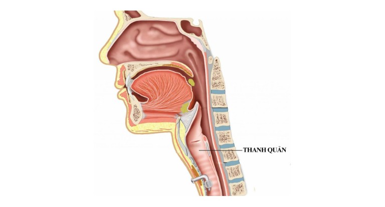 viêm thanh quản bị mất tiếng