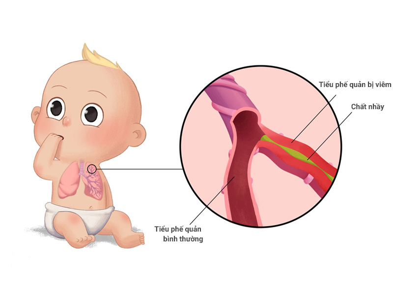 bé bị viêm tiểu phế quản