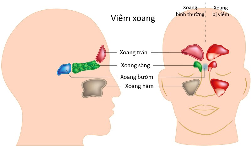 viêm xoang gây ho kéo dài
