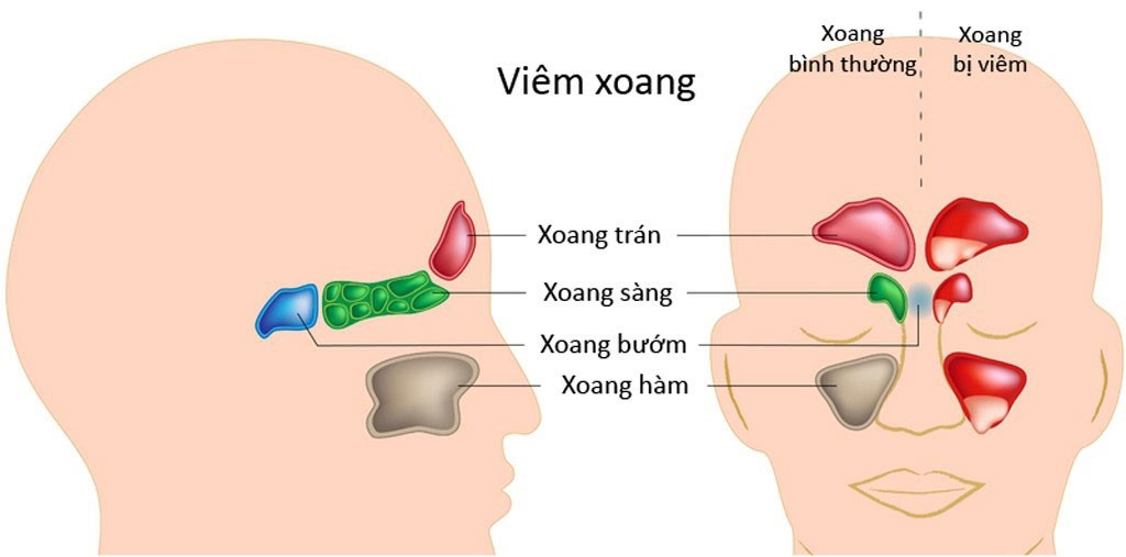 nghẹt mũi ù tai nhức đầu