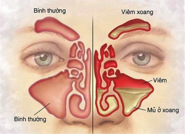 thuốc viêm xoang gia truyền