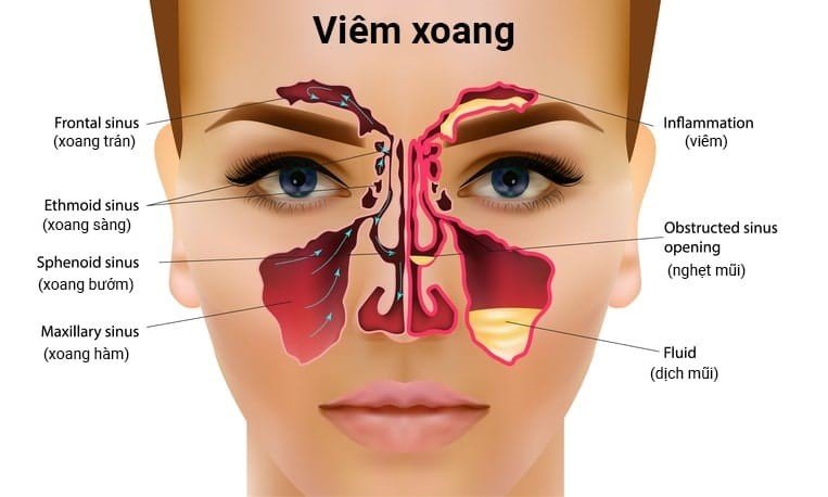 Viêm xoang là tình trạng các xoang bị tắc nghẽn và chứa đầy chất lỏng