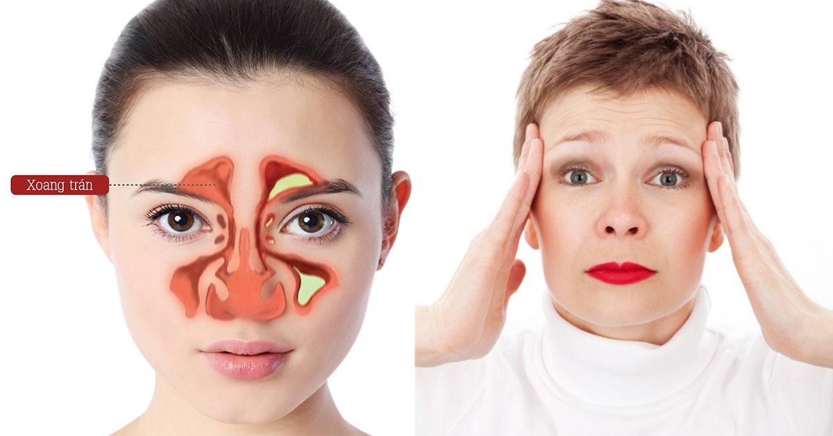 thuốc trị viêm xoang trán