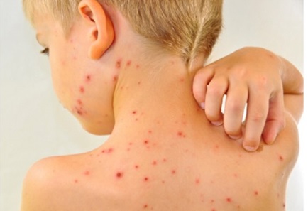 Virus varicella zoster có khả năng tồn tại thể ngủ trong cơ thể người đã bị thủy đậu