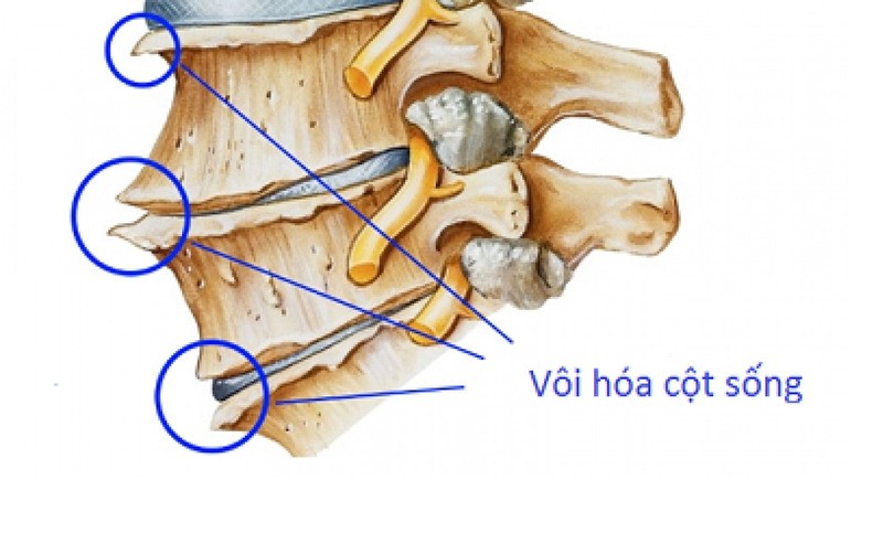 vôi hóa cột sống