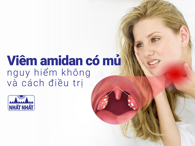 viêm amidan có mủ