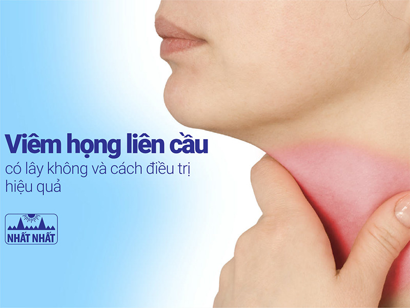 Viêm họng liên cầu