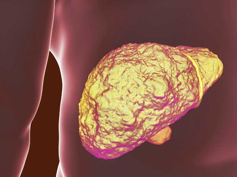 bệnh xơ gan có lây không