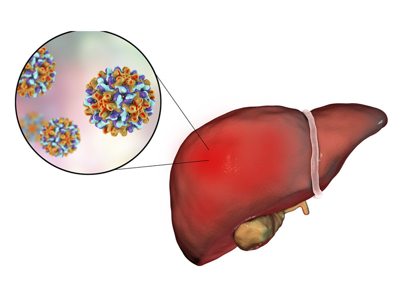 xơ gan có nguy hiểm không