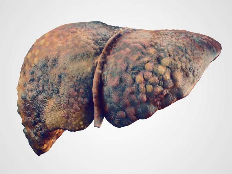 xơ gan có lây không