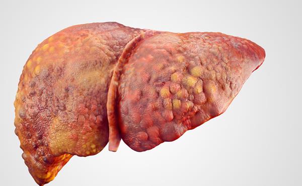 Xơ gan là biến chứng khi bị men gan cao