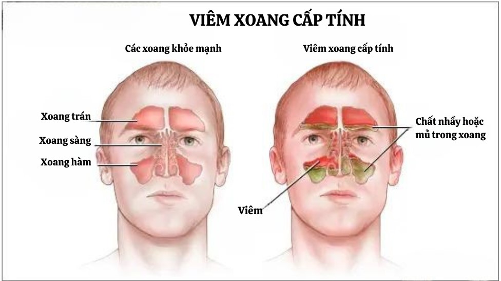 Xoang khỏe mạnh và Viêm xoang cấp tính