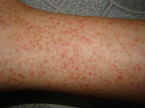 Xuất huyết dưới da do sốt xuất huyết