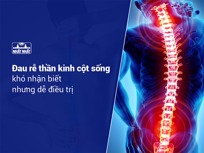 Đau rễ thần kinh cột sống