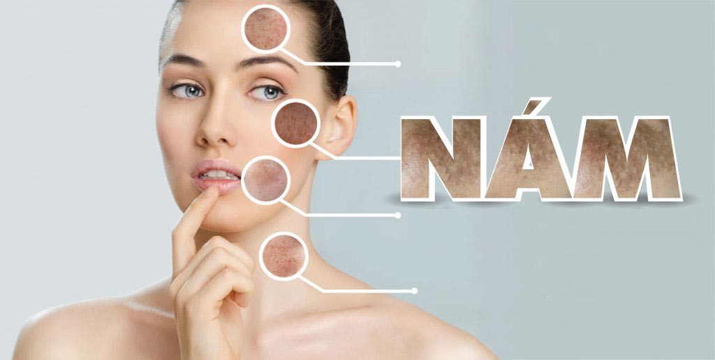 Khoảng 70% các mẹ mang thai gặp tình trạng da mặt bị nám