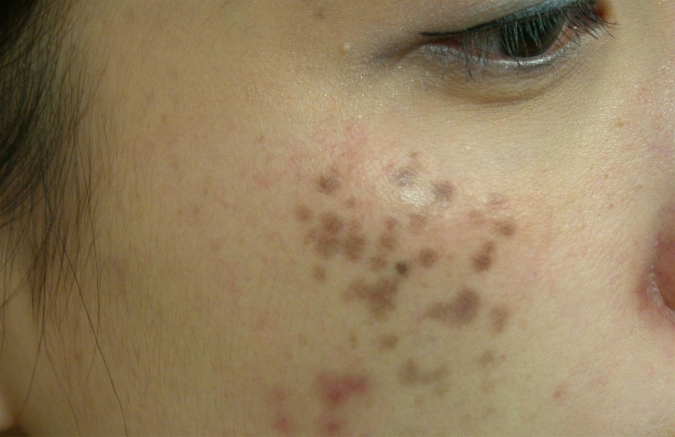 Nám đốm là một loại nám khó chữa trị