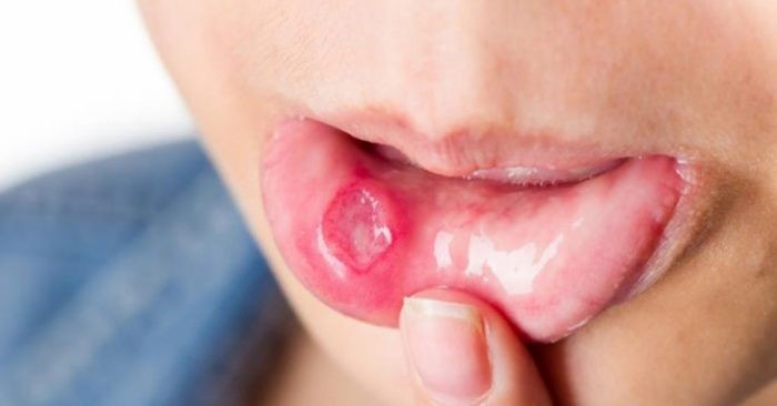 Giai đoạn ổ loét thường gây nhiều đau đớn khó chịu cho người bệnh