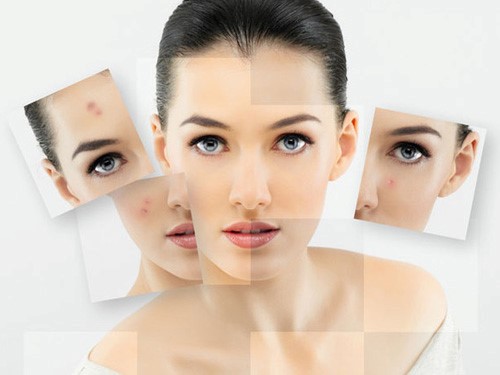 Nên ưu tiên sử dụng trị mụn dạng kem cho da khô mụn