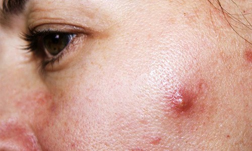 Da nhờn mụn và lỗ chân lông to thường đi đôi với nhau