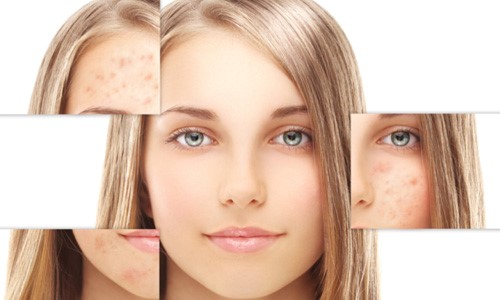 Nên ưu tiên loại sữa rửa mặt dành cho da nhạy cảm dịu nhẹ