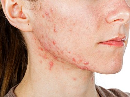 Da khô mụn rất nhạy cảm nên khi rửa phải thật nhẹ nhàng