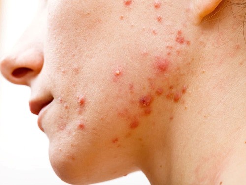 Mụn trứng cá ẩn – Loại mụn phát triển khá nặng trên mặt