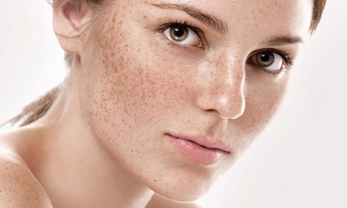 Phòng tránh tàn nhang sẽ hiệu quả và tốt hơn là trị tàn nhang trên da