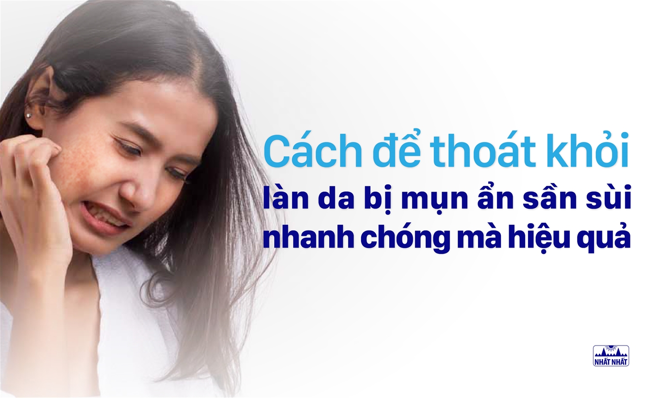 Sữa rửa mặt cho da mụn ẩn Lenka – Làm sạch mà không gây kích ứng, khô da