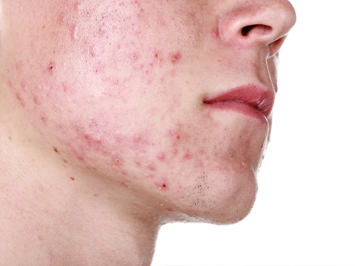  Cần bỏ túi các giải pháp chăm sóc cho da mụn để phòng ngừa mụn và tránh mụn phát triển