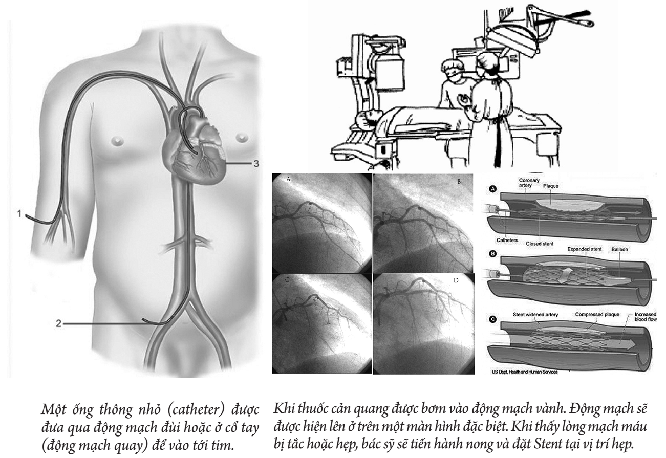 đặt Stent động mạch vành
