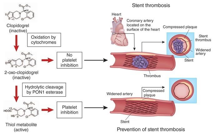 Ảnh: Clopidogrel là thuốc chống kết tập tiểu cầu trước và sau khi đặt Stent
