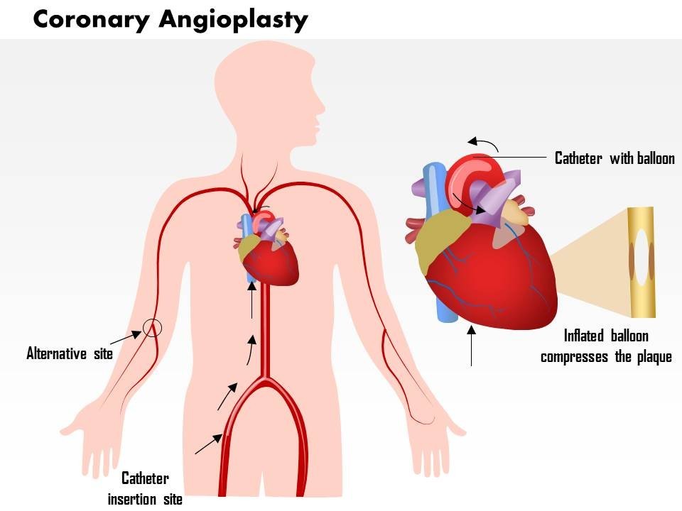 Ảnh: Vị trí can thiệp động mạch vành thường gặp: bẹn, cổ thay, khuỷu tay