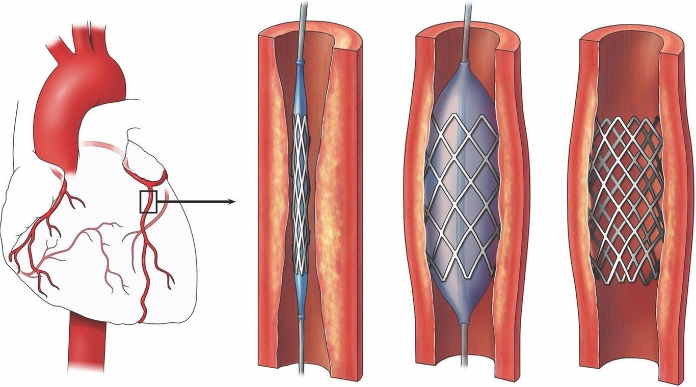 Ảnh: Đặt Stent đông mạch vành